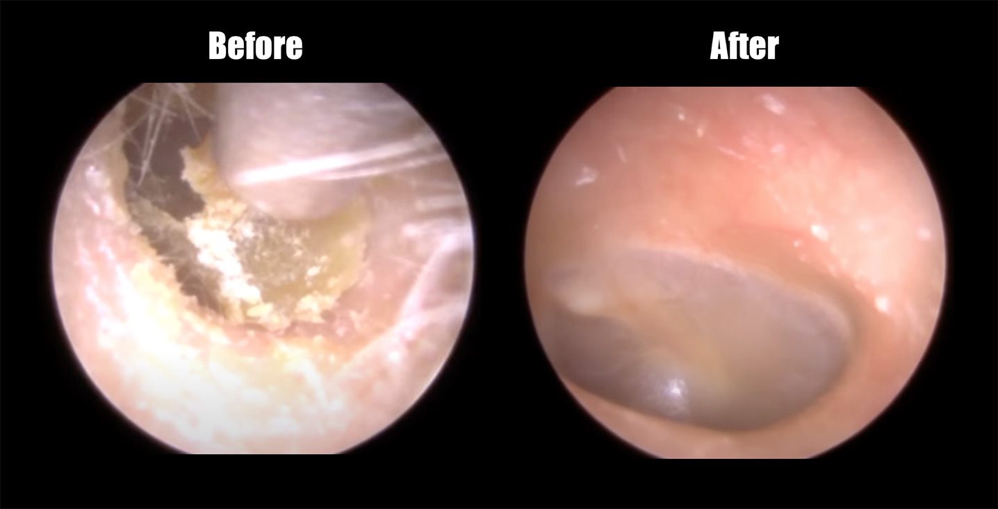 Before and after earwax removal and ear cleaning at Flex Audiology inside the ear image